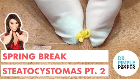 Steatocystoma Station Dr Pimple Popper