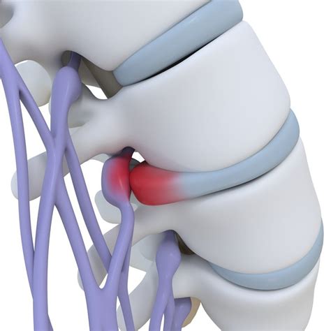 What Is A Bulging Disc Biospine Institute