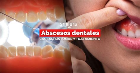 ¿qué Son Los Abscesos Dentales Causas Síntomas Y Tratamiento
