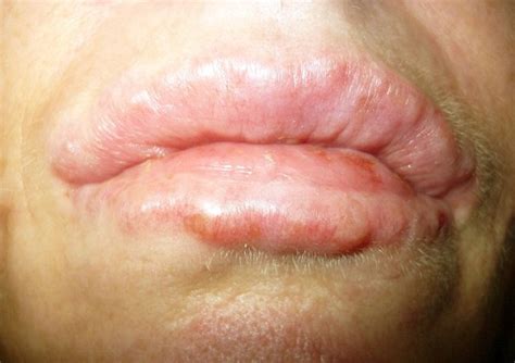 Swollen Bump On Lip Images And Photos Finder