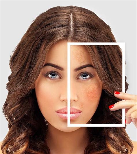 Home Remedies For Skin Pigmentation How To Reduce Dark Spots In 2020