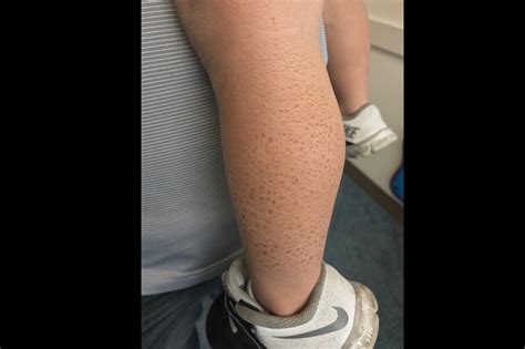 Dry Scaly Skin In A Young Boy Clinical Advisor