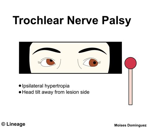 Trigeminal Nerve Palsy