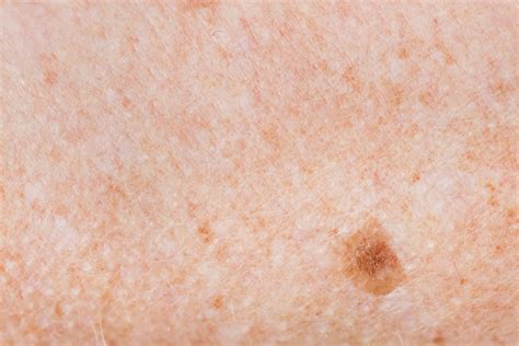 Abcde S Of Melanoma Skin Joy Dermatology Austin Dermatologist 10736 Hot Sex Picture