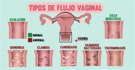 ¿por Qué Se Produce El Flujo Vaginal Ginecólogos En Guadalajara