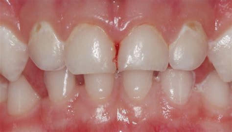 Caries Management In Pediatric Dentistry Decisions In Dentistry