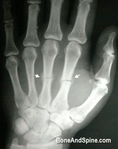 Metacarpal Fracture Xrays Bone And Spine Fracture The Unit Image