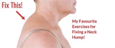 Quick 4 Minute Fix For A Neck Hump With Free Exercise Sheet Milton