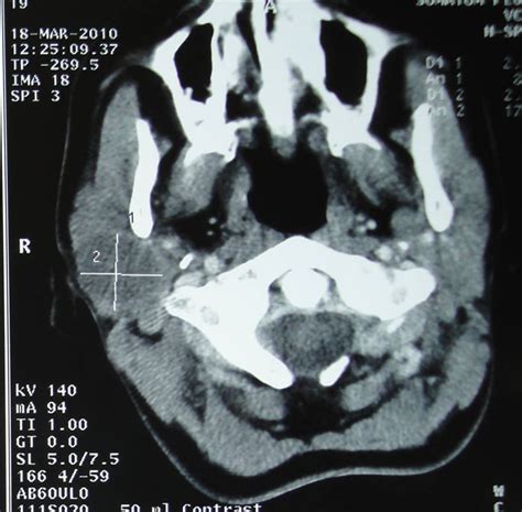Axial Ct Scan Showing A Right Parotid Gland Pleomorphic Adenoma With