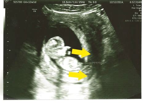 12 week ultrasound gender reveal mother rising ultrasound gender 12 week ultrasound gender
