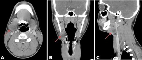 Pleomorphic Adenoma Of The Submandibular Gland Journal Of Case Reports And Images In Dentistry