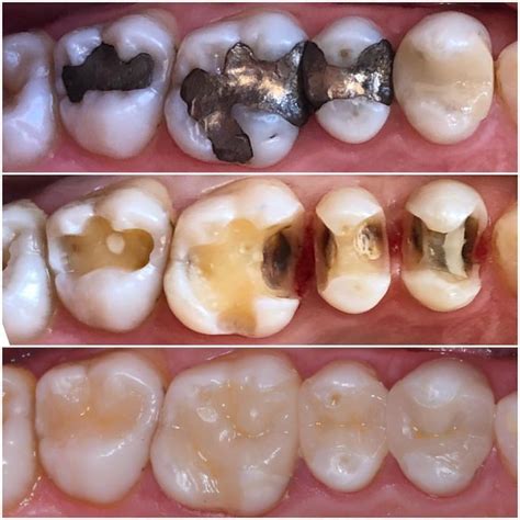 What Is Amalgam And Composite Fillings