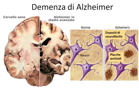 Β AMILOIDE Y ALZHEIMER Enriquerubio net