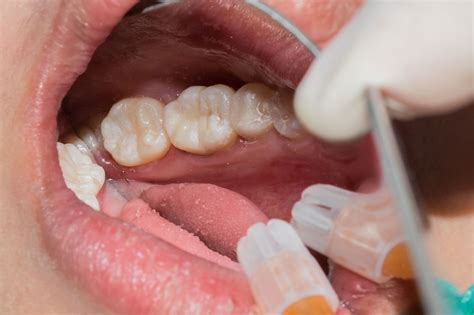 White Dental Fillings For Your Cavity South Gables Dental