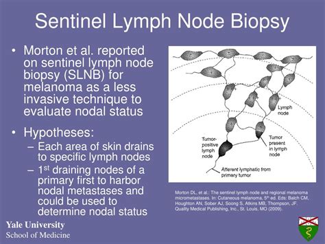Ppt Surgical Treatment Reason For Sentinel Node Biopsy Powerpoint