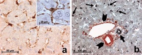 Cltx) from 2005 to june 2013. 1. Immunohistochemistry for cellular retinol-binding protein-1 (CRBP-1)... | Download Scientific ...