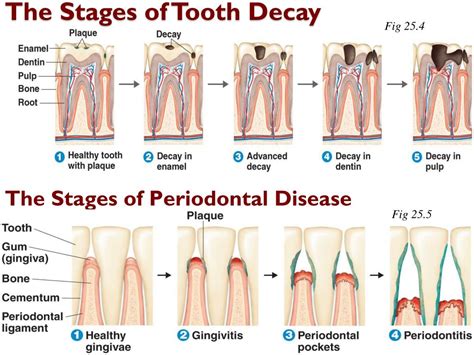 5 Stages Of Tooth Decay