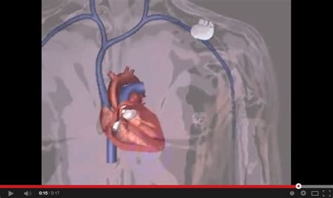 How Pacemakers Work Boston Scientific