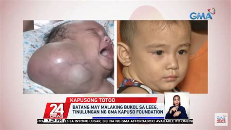 2 Year Old Child With Huge Neck Lump Gets Surgery With Gma Kapuso
