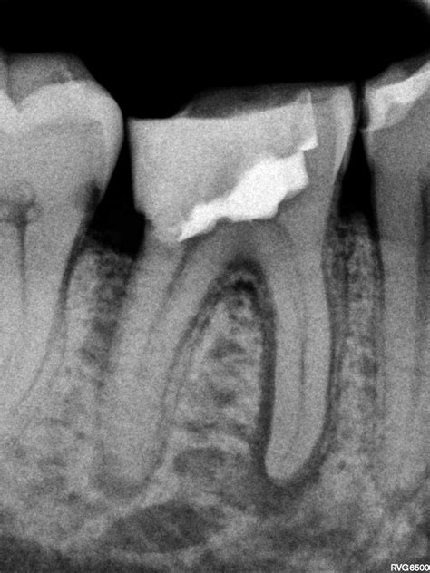 The Lazy Mans Guide To The Microbial Causes Of Primary Apical