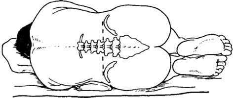 Procedure For Performing A Diagnostic Lumbar Puncture And Administration