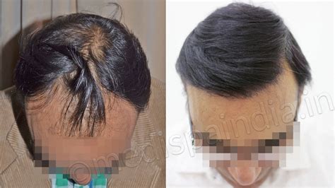 So, the costs vary from patient to patient. Hair Transplant Centre in Delhi-Jaipur: Why FUT+FUE Hair ...