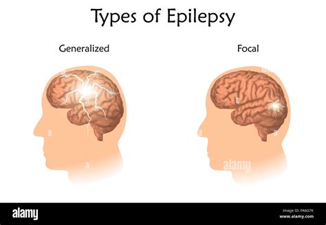 Types Of Epilepsy Illustration Showing Generalized And Focal Epilepsy