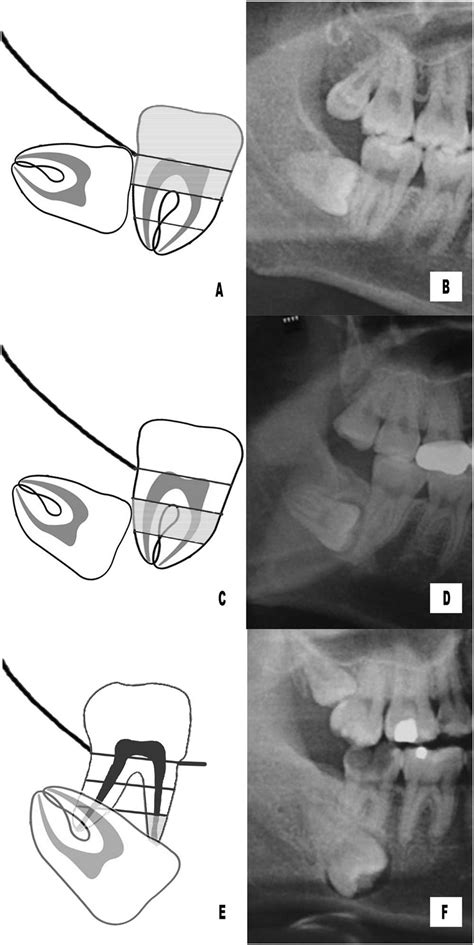 Position Classification Of Horizontal Impacted Mandibular Third Molars