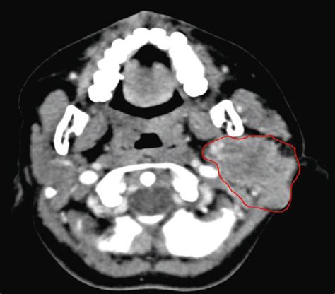 A Axial Plane Of Ct Neck Soft Tissue With Contrast Shows A Large
