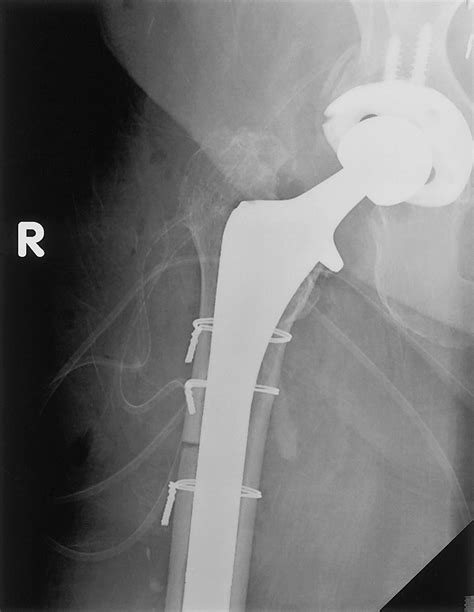 Cerclage Wires Used In Revision Noncemented Total Hip Arthroplasty A