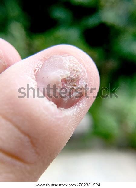 Fungal Nail Infection Damage On Human Stock Photo 702361594 Shutterstock