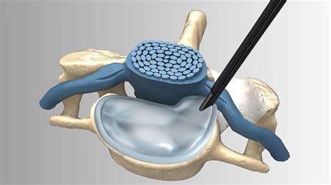 Posterior Cervical Foraminotomy Minimally Invasive Spine Surgery