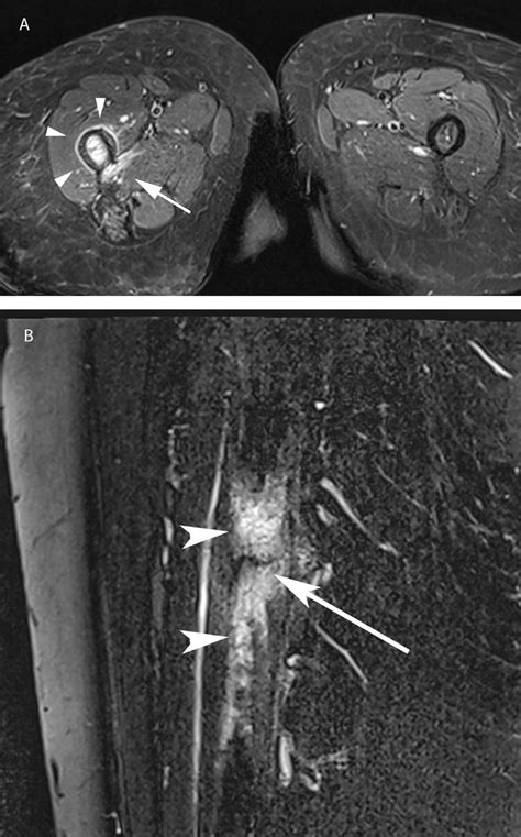 A Right Proximal Femur Mri Axial T2 Weighted Inversion Recovery Ir
