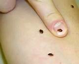 Home Remedies To Eradicate Bed Bugs Images