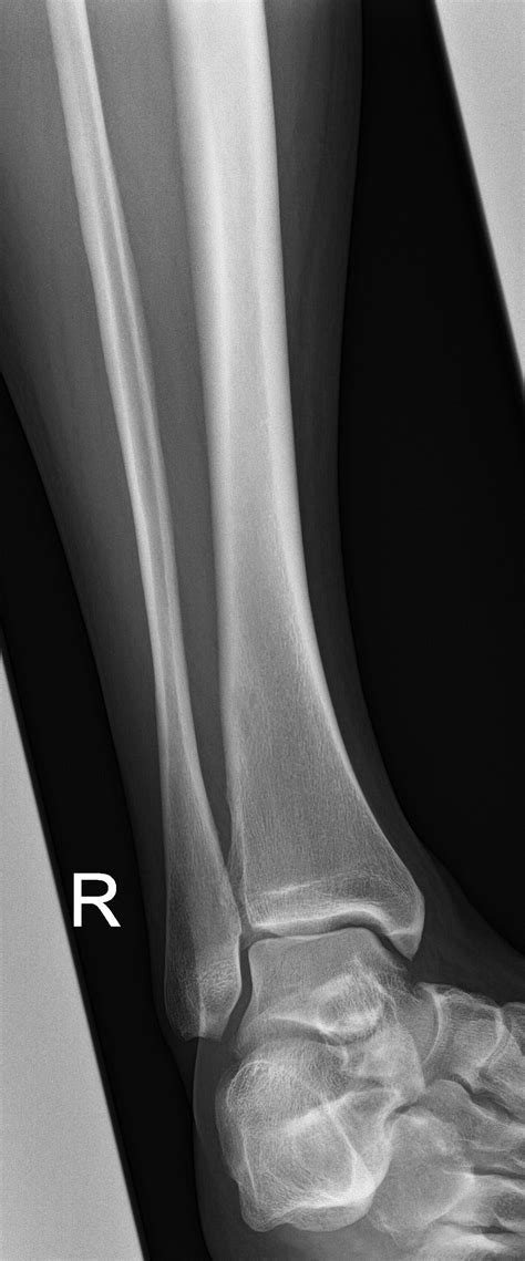 Medial Tibial Stress Syndrome Image