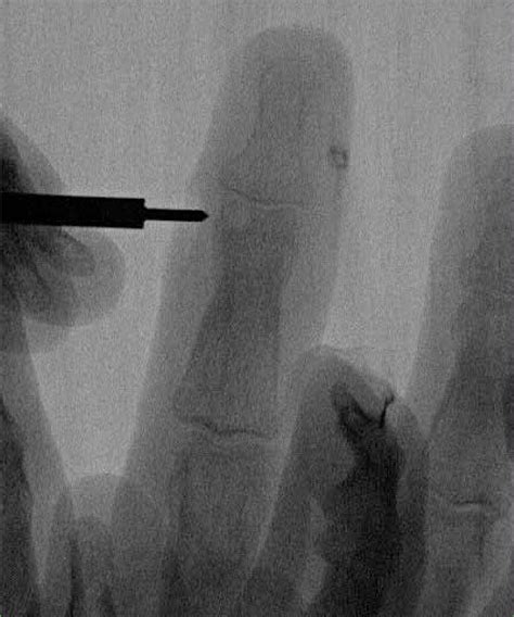 Case 2 Intraoperative Localization Of The Lesion Using Fluoroscopy