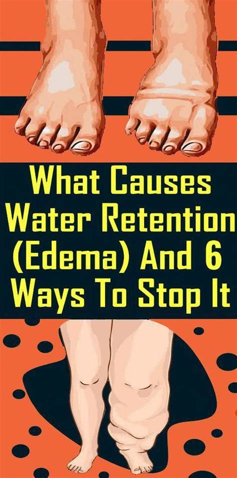 6 Simple And Effective Home Remedies For Water Retention