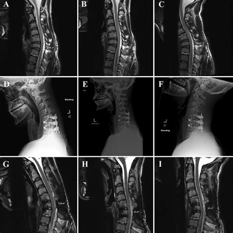 Preoperative Sagittal T Weighted MR Images Of The Cervical Spine Download Scientific Diagram
