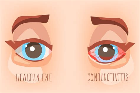 Viral Eye Infection Types Symptoms Treatment Stdgov Blog