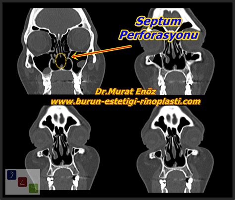 What causes a perforated nasal septum? Health Zone Turkey: Symptoms, Causes and Diagnosis of ...