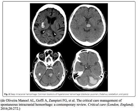 Critical Intracranial Hemorrhage: Pearls and Pitfalls in Evaluation and