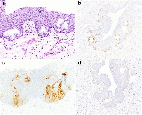 A Prostatic Metaplasia Is Characterized By Patchy Glandular