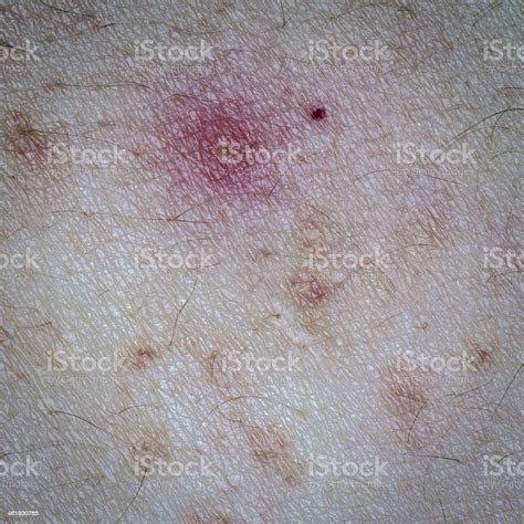 Allergic Rash Dermatitis Eczema Skin Stock Photo Download Image Now