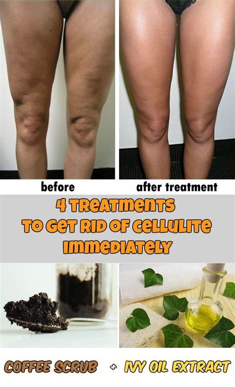 4 Treatments To Get Rid Of Cellulite Immediately