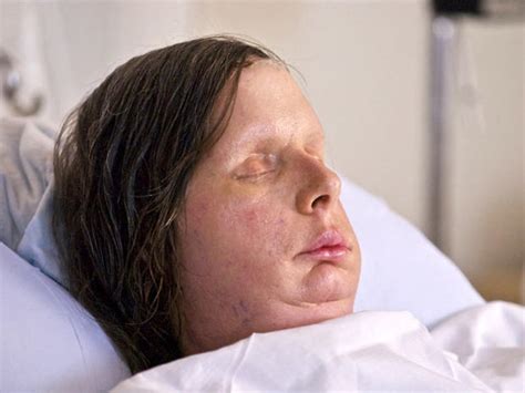 chimp attack victim charla nash reveals new face pictures cbs news