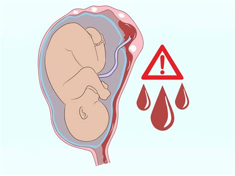 Simple Ways To Deal With Fibroids During Pregnancy 9 Steps
