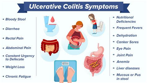 Ulcerative Colitis Uc Symptoms Causes Diagnosis Treatment