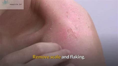 How To Handle The Itch Of Psoriasis Youtube