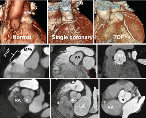 Right Ventricle Outflow Tract Radiology Key