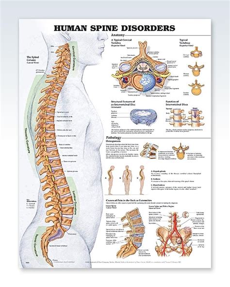 A bone is a rigid tissue that constitutes part of the vertebrate skeleton in animals. Human Spine Disorders Exam Room Anatomy Poster - ClinicalPosters